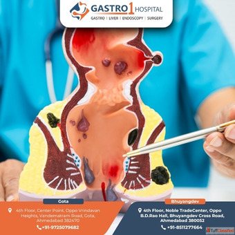 Expert Fissure Doctor in Ahmedabad for Safe and Effective Treatment Solutions