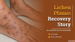 Lichen Planus Treated Successfully By Homeopathy At Life For...