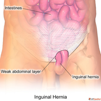 Indirect Inguinal Hernia Symptoms Causes and Treatment Options