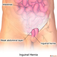 Indirect Inguinal Hernia Symptoms Causes and Treatment Optio...