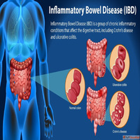 Chronic Inflammatory Bowel Disease Symptoms Diagnosis and Tr...