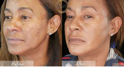 Laser Treatment for Hyperpigmentation in Kingston Ontario