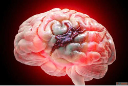Brain Hemorrhage Treatment Cost Affordable Advanced Care in ...