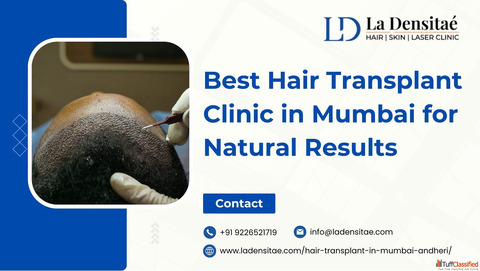 Best Hair Transplant Clinic in Mumbai for Natural Results