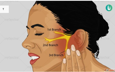 Get Trigeminal Neuralgia Homeopathic Treatment in Zirakpur