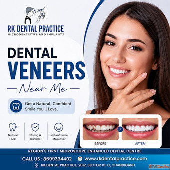 Dental Veneers Near You for a Perfect Smile Transformation