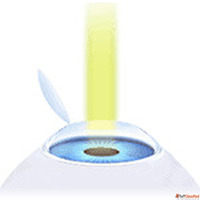 Lasik Eye Surgery - Advanced Specs Removal Surgery in India