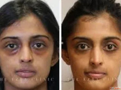 Eyelid Surgery Blepharoplasty in Mumbai Dr. Hemang Sanghvi