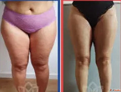 Thigh Liposuction in Mumbai Thigh Fat Removal by Dr. Hemang ...