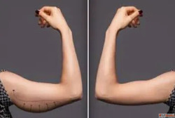 Arm Liposuction Arm Skin Removal by Dr. Hemang Sanghvi