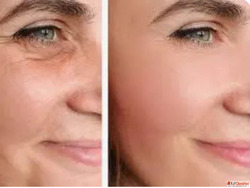 Facelift Surgery in Mumbai By Dr. Hemang Sanghvi - Face Lift...