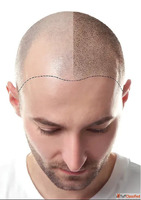 Scalp Micropigmentation in Mumbai Hair Transplant Surgeon Dr...