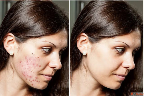 Reasons for Acne on Cheeks How to Get Rid of Cheek Acne