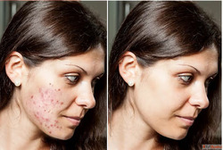 Reasons for Acne on Cheeks How to Get Rid of Cheek Acne