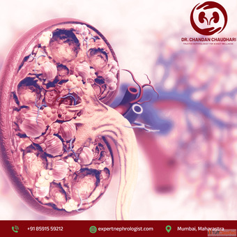 Expert CKD Treatment in Mumbai Dr. Chandan Chaudhari