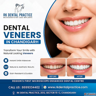 Dental Veneers Near You for a Perfect Smile Transformation