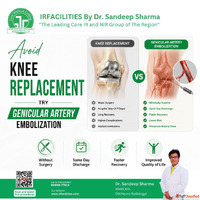 Genicular Artery Embolization A Minimally Invasive Solution ...