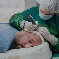 Modern Hair Transplant Techniques in Delhi for Permanent Hai...