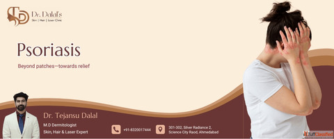 Best Psoriasis Treatment in Ahmedabad - Skin Specialist