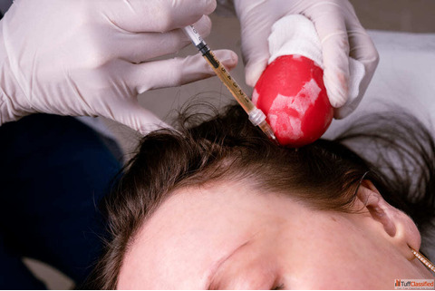 Top benefits of getting PRP Treatment in Dubai
