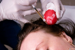 Top benefits of getting PRP Treatment in Dubai