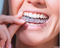 Best Clear Teeth Aligners Clinic in Ahmedabad The Dental Wel...