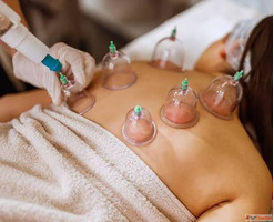 Cupping Therapy Services Natural Pain Relief and Holistic He...