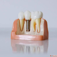 dental implant treatment in surat