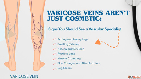 Varicose Veins Treatment in Delhi Without Surgery - Dr Akash Bansal
