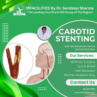 Carotid Stent Procedure - Stroke Prevention Method IRFacilit...