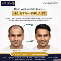 Hair Transplant Clinic Kammasandra with Experienced Surgeons...