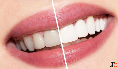 Get Whiter Teeth with Professional Whitening