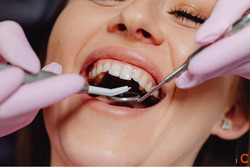 Dental Implants in Brampton Replace Missing Teeth with Confidence