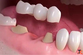 Artificial Teeth Services in Indore Dr Atul Jajoo
