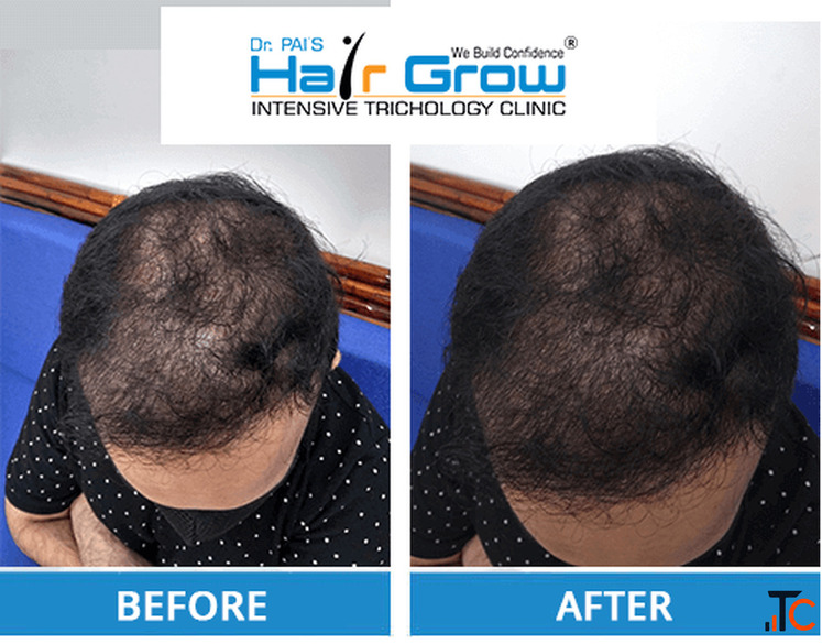 Best Hair Clinic in Thrissur Your Complete Guide to Advanced Hair Care and Lasting Hair Restoration