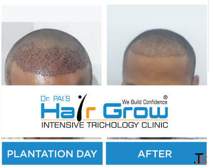Thrissur Hair Transplant A Complete Guide to Natural Hair Restoration and Lasting Confidence