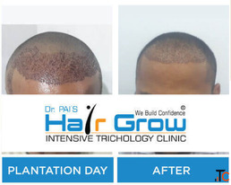 Thrissur Hair Transplant A Complete Guide to Natural Hair Restoration and Lasting Confidence