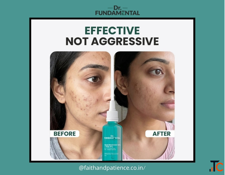 Moisturizer for Oily Acne Prone Skin - Non-Comedogenic Formula