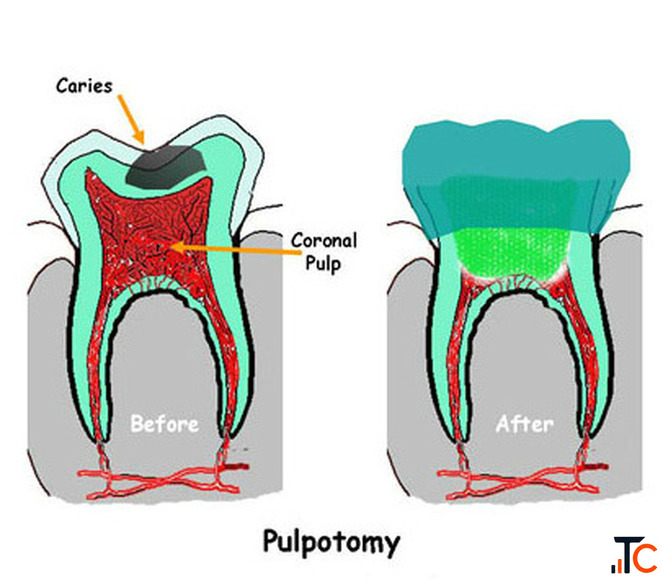 Expert Pulpectomy Treatment in Ahmedabad The Dental Wellness Centre