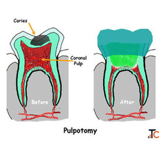 Expert Pulpectomy Treatment in Ahmedabad The Dental Wellness Centre
