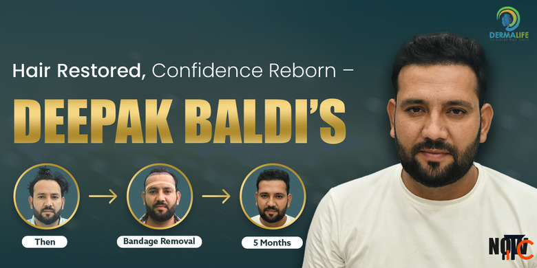 What is the Cost of Hair Transplant in Delhi Dermalife
