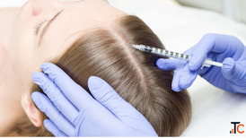 Hair Transplant Thrissur Your Complete Guide to Natural Hair Restoration