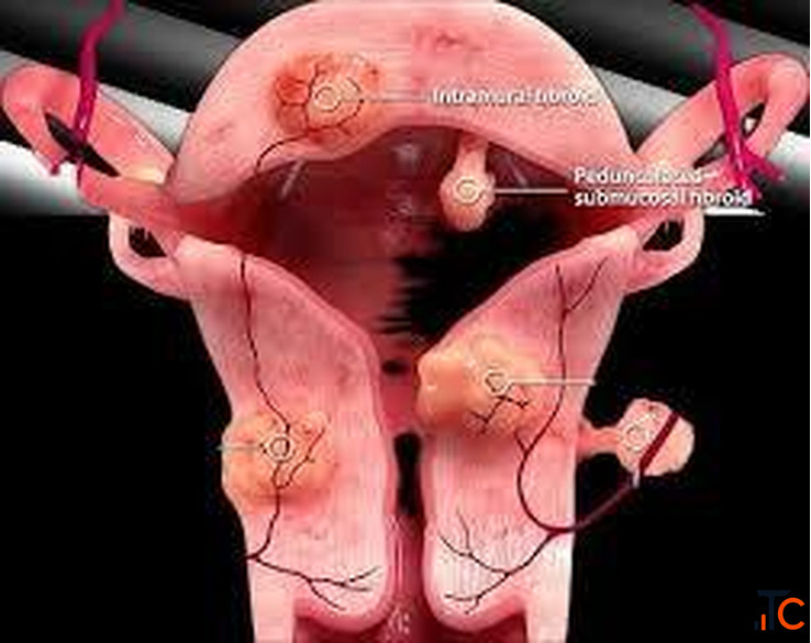 UFE Uterine Fibroid Embolization - Safe Non-Surgical Fibroid Treatment IRFacilities