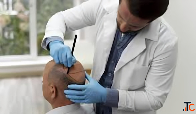 Delhi's Most Trusted Hair Transplant Premium Care at the Right Price