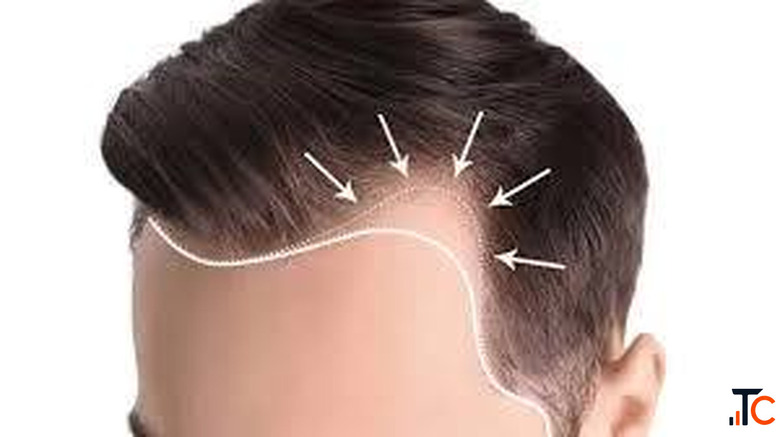Delhi's Most Trusted Hair Transplant Premium Care at the Right Price
