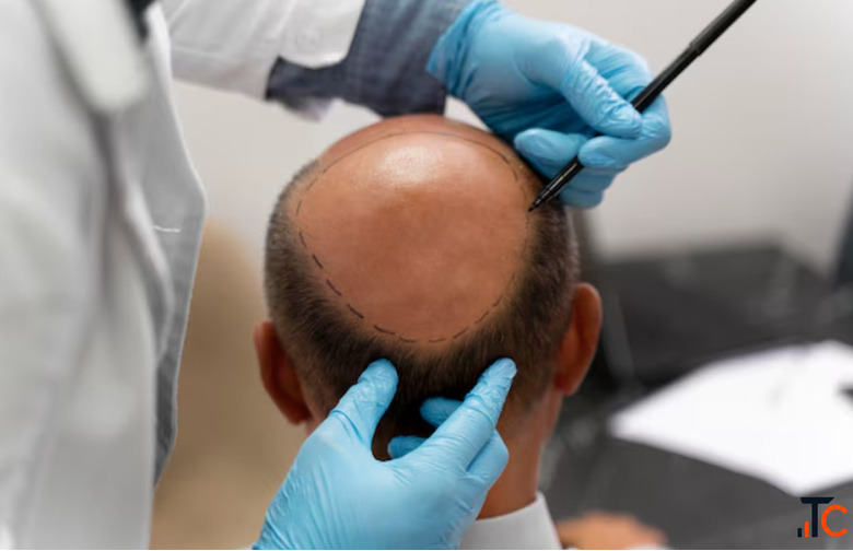 Hair Transplant Cost in Delhi Full Price Details