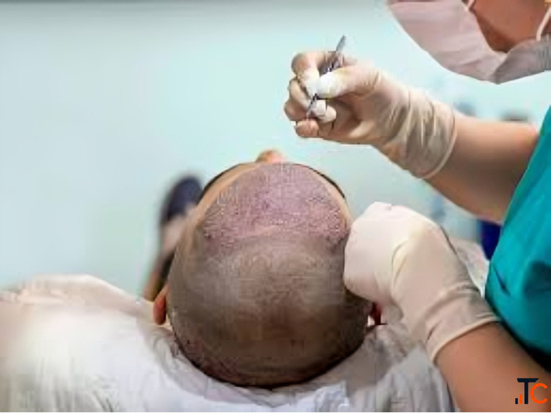 Affordable Hair Restoration Without Compromising Quality