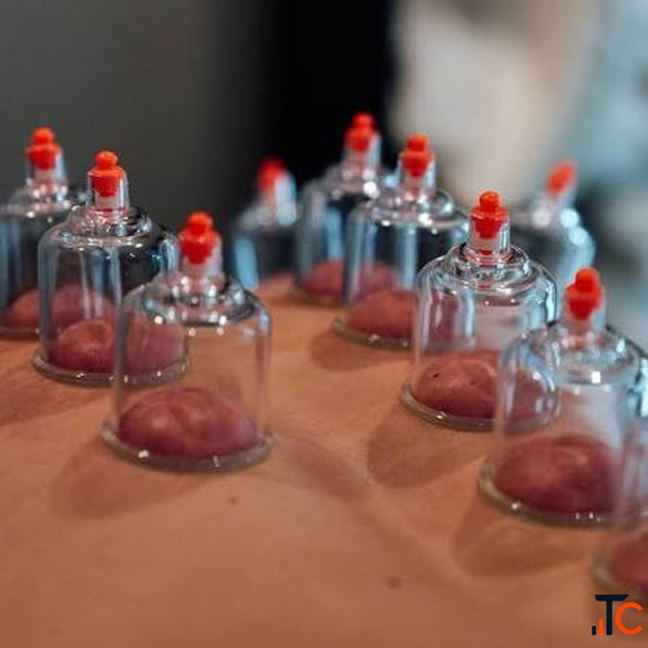 Best Cupping Therapy Services in Gurgaon Pain Relief Recovery