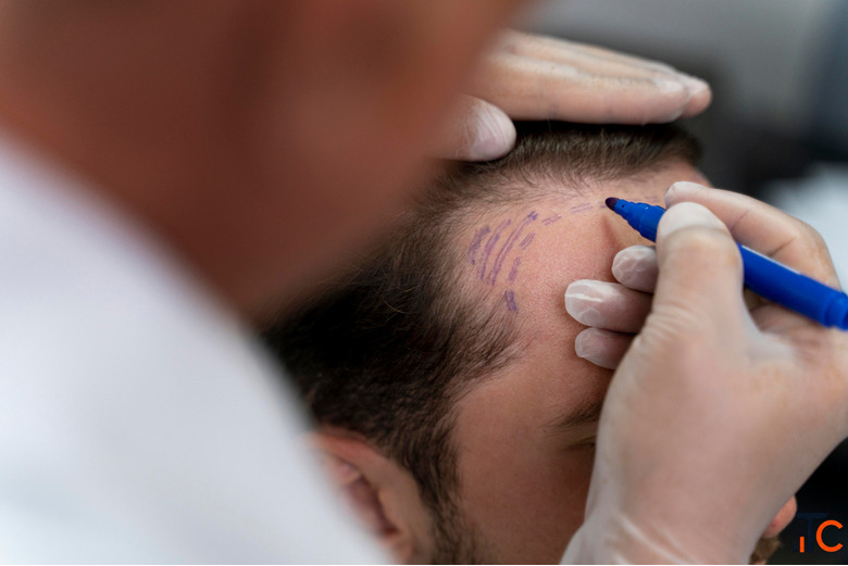 Hair Transplant Clinic in Kochi Your Trusted Partner for Natural Hair Restoration