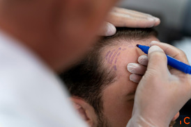 Hair Transplant Clinic in Kochi Your Trusted Partner for Natural Hair Restoration